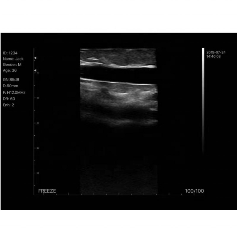 WIFI Wireless Color Probe GYN Ultrasound Linear Probe With Display Anesthesia Puncture Navigation Handheld Ultrasound