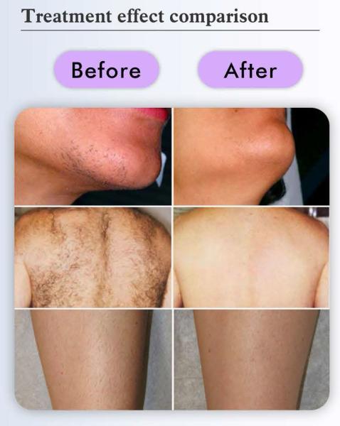 755nm Alexandrite Laser 1064nm Long Pulse Nd Yag Laser Hair Removal Stationary Candle