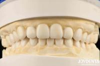 Dental Biomimetic Aesthetic Diagnostic  Wax-Up Of Veneers