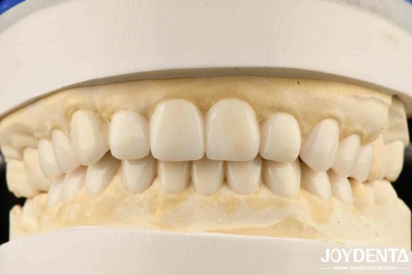 Dental Biomimetic Aesthetic Diagnostic  Wax-Up Of Veneers