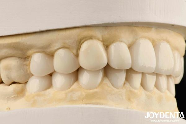 Dental Biomimetic Aesthetic Diagnostic  Wax-Up Of Veneers