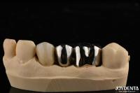 Abrasion Resistant Metal Alloy Crown For Customized Dental Restorations