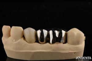 Abrasion Resistant Metal Alloy Crown For Customized Dental Restorations