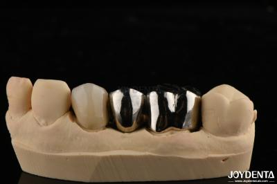 Abrasion Resistant Metal Alloy Crown For Customized Dental Restorations