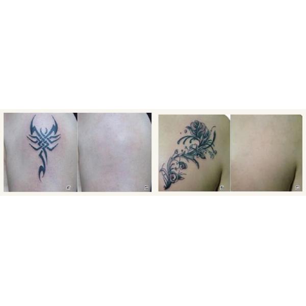 Q Switch ND YAG Laser Tattoo Removal Equipment , Carbon Peeling Picosecond Laser Machine