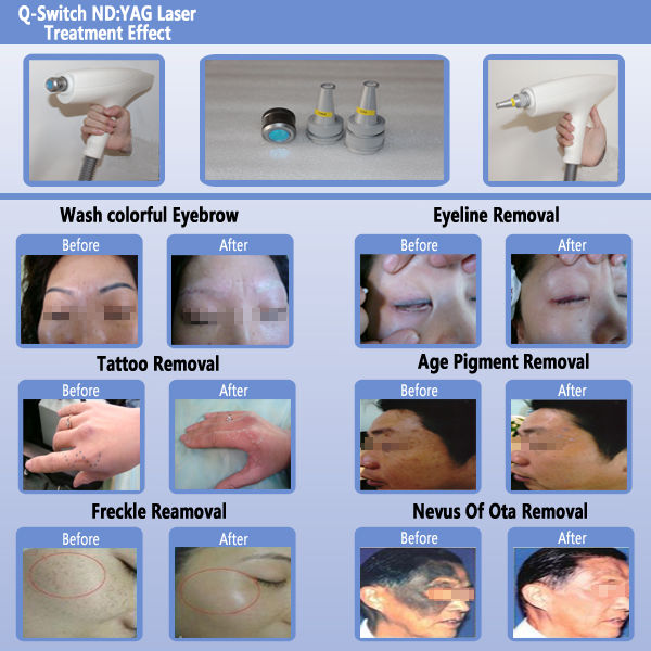 Pigment Removal Whole Body Tattoo Removal Q Switch Nd Yag Laser Handpiece
