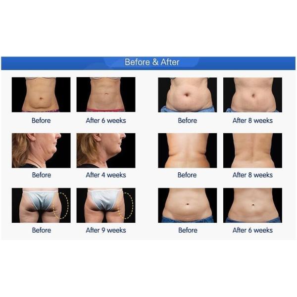 CE / FDA approved 5 treatment handles 10.4 inch screen cool tech fat freezing cryolipolysis