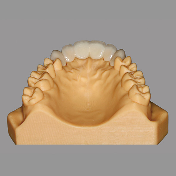 China Outsourcing Dental Lab | Aesthetic Porcelain Fused To Zirconia Bridge Hypoallergenic
