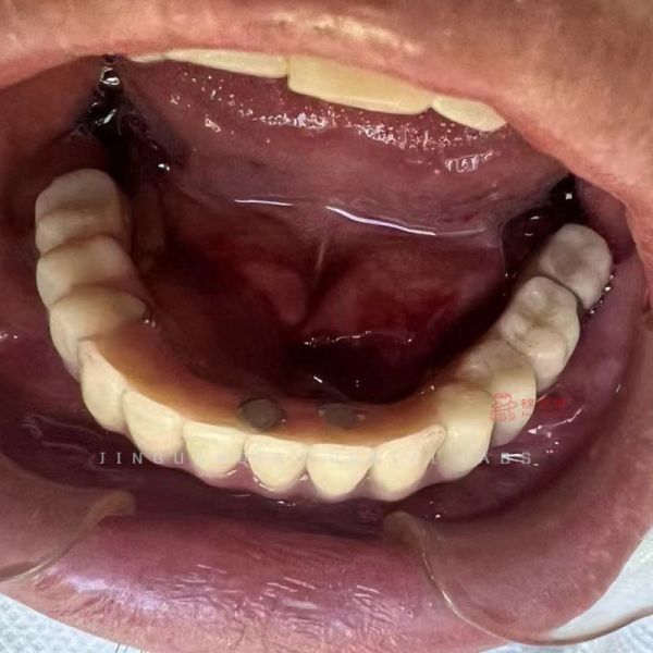3D Printer Zirconia Crown and Bridge Hybrid Dental Implant with Titanium Abutment