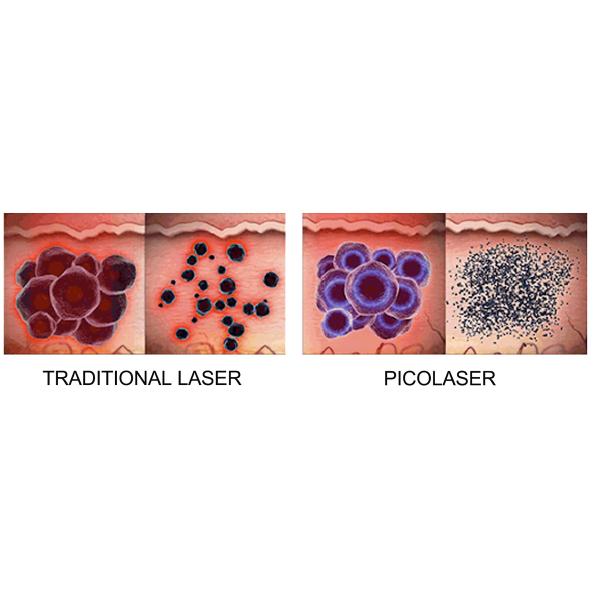 450ps Picolaser Q Switched Nd Yag Laser 1064nm 532nm Stationary