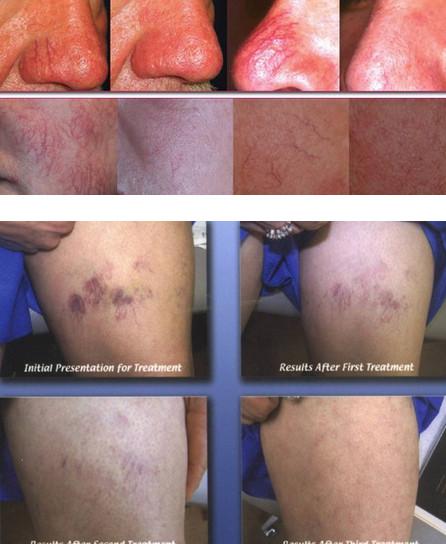 ce approved spider vein removal machine/portable home use spider vein removal machine