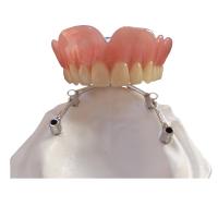 Implantes dentales de la corona FDA del implante del diente de COCR con la barra del titanio