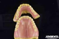 Desbloquee el potencial de su práctica dental Dentadura acrílica con una propiedad diversa y ligera