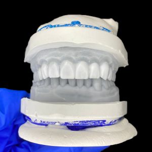 Diagnostic Wax-Up for Porcelain Veneers