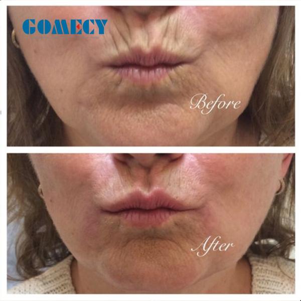 Nova Tecnologia Peface Strong Pulsed Ems Facial Muscle Building Facial Machine para Face V Shape Face Lift