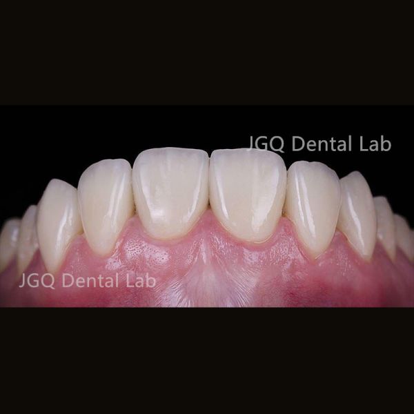 3D Printer Zirconia Crown and Bridge Hybrid Dental Implant with Titanium Abutment