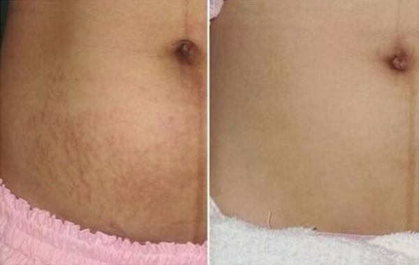 New product ideas 40W medical fractional CO2 laser for Acne removal and scar removal beauty equipment