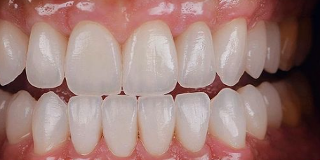 1200 Mpa Aesthetic Zirconia Blocks Dental D98 Open System 57% Translucent