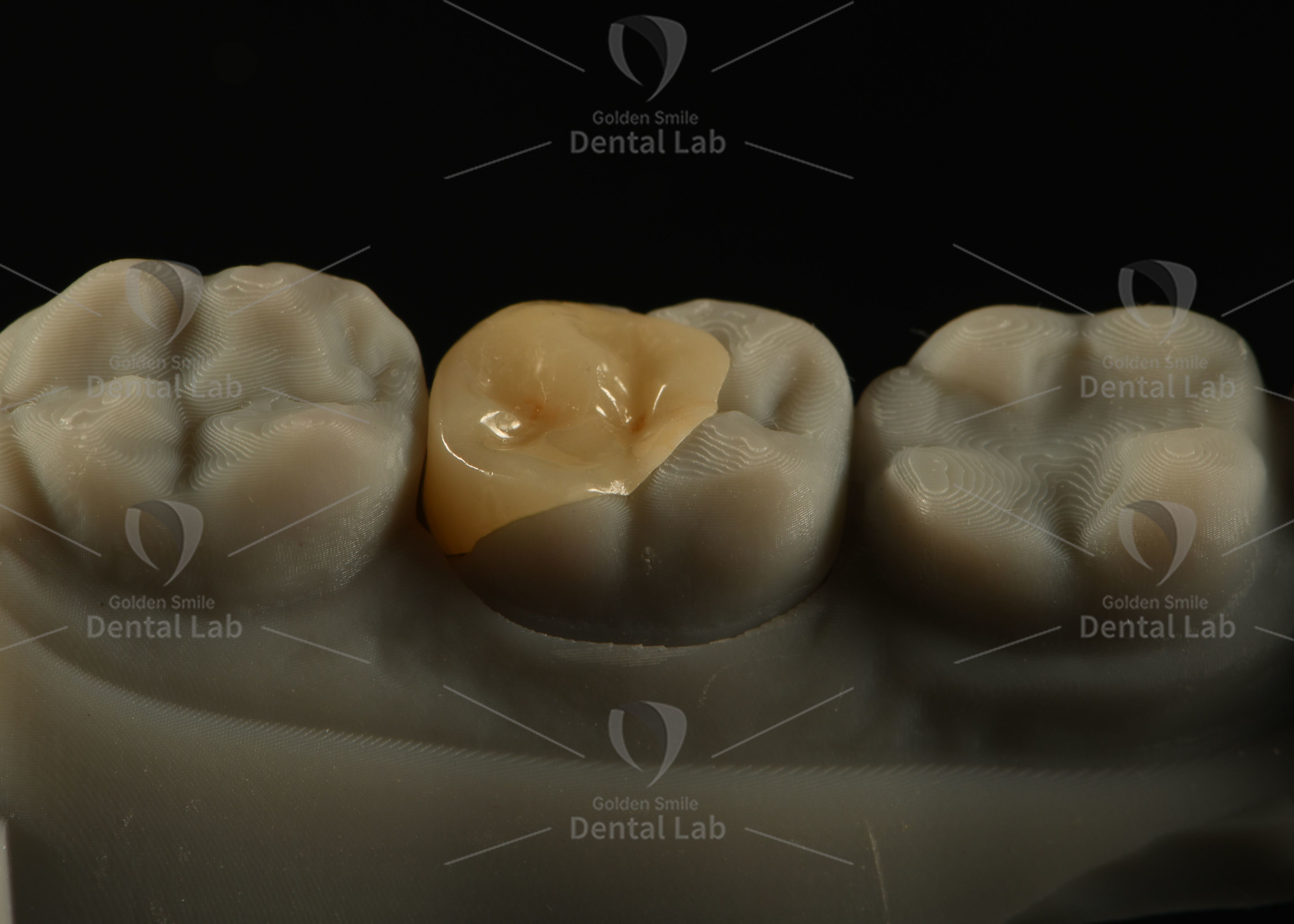 Custom Metal-free Full-Zirconia Crown and Inlay with High Fracture Resistance and Precise Marginal Fit