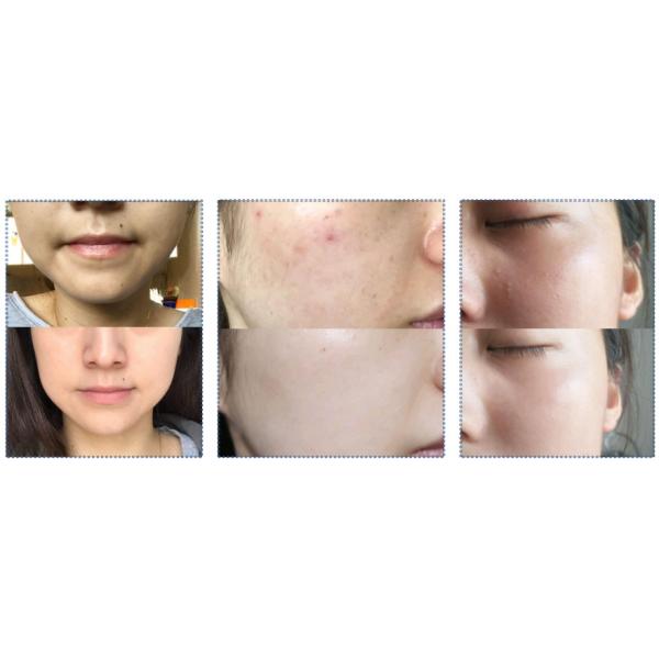 Hot Sell Portable 532 1064 1320nm Tattoo Scar Pigment Eyebrows Darker Spots Removal Machine 3 Wavelengths Skin Care 5PCS