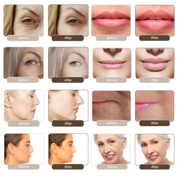 CE заполнителя глубокой подводной лодки-Q Кореи Revolax отлично Hyaluronic кисловочный дермальный