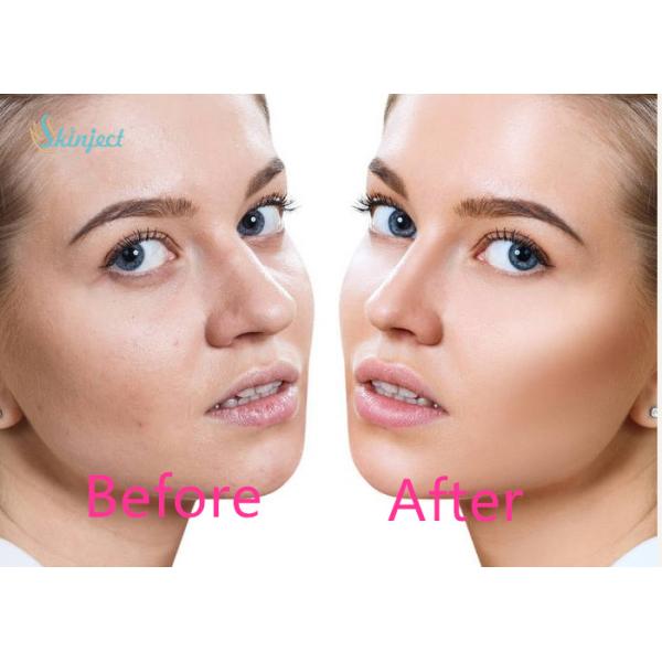 Пушечная батарея впрыски Skinject Mesotherapy врезала