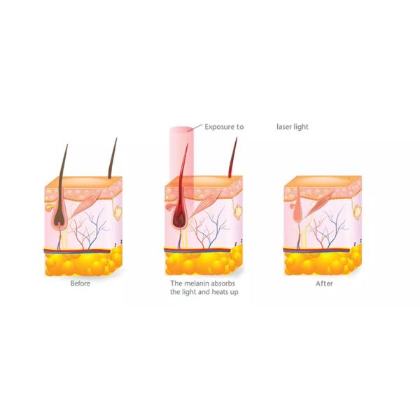 Soprano Xl Ice Alma 808nm Diode Laser Hair Removal Machine CE Approval