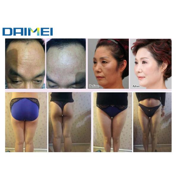 Non Invasive HIFU Beauty Machine 5 10000 Shots Cartridges For Salon / Clinic Spa