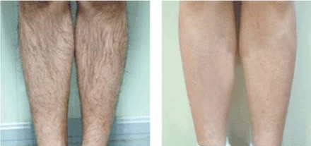 OEM design 4S multiple 2 display Beauty Machine-IPL&RF&E-light&Nd:YAG laser system