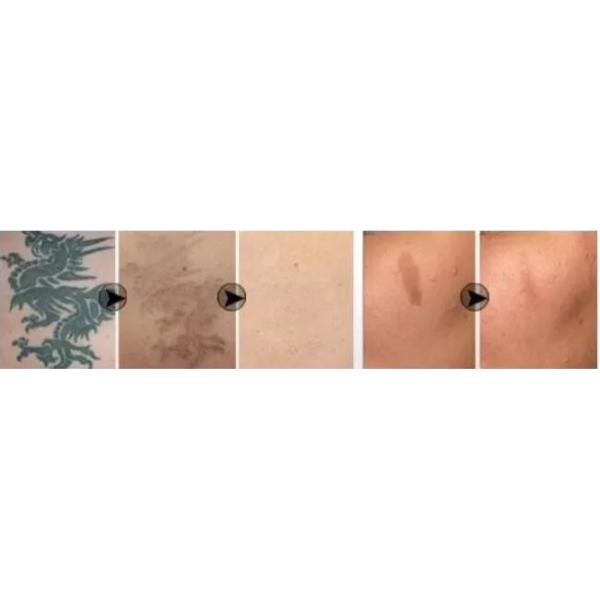 переключенная к машина лазера яг нд