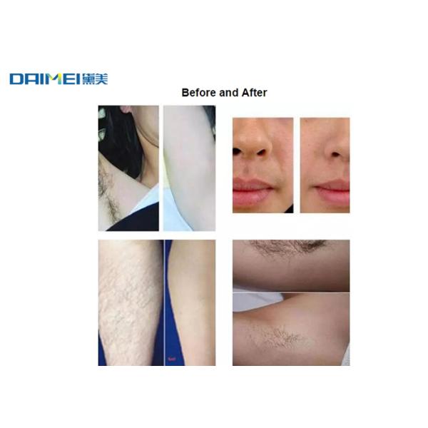 Professional OPT Hair Removal Machine / IPL Permanent Hair Reduction
