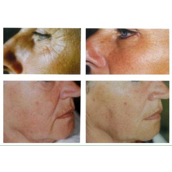 Non-Invasive Body Care INDIBA Proionic System: Reduce Wrinkles, Stretch Marks & Localised Fat Burning & Face Lifting