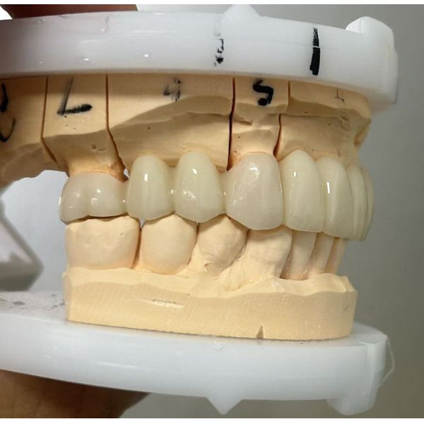 Full Zirconia dental bridge for high strength and durable dental restoration