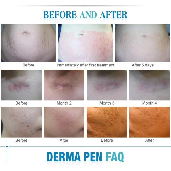 6 in 1 Derma Roller Kit with Ice Roller Skin Cooling Derma Care Facial Beauty NO Plugs Type