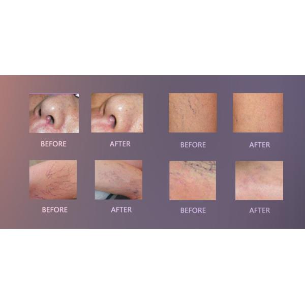 30MHz RBS Spider Vein Removal Machine for Vein Removal machine