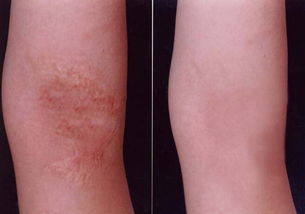 Warts Removal Fractional Co2 Laser Equipment Gray + White Color For Skin Tightening