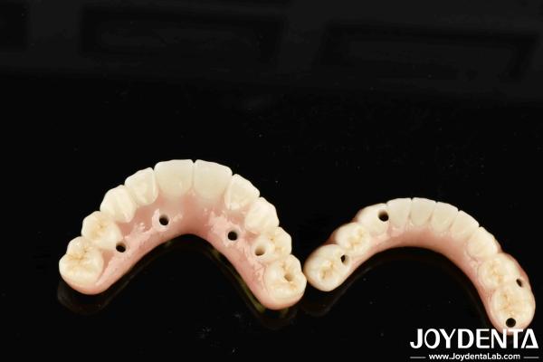 High Durability Ti-Bar Zirconia Hybrid Bridge For Achieving Aesthetics