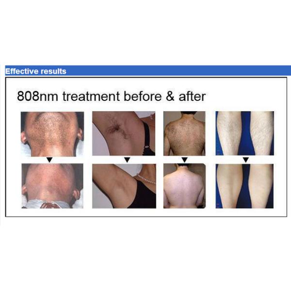 CE Approved 2000W 808nm Diode Laser Bikini Hair Removal Machine