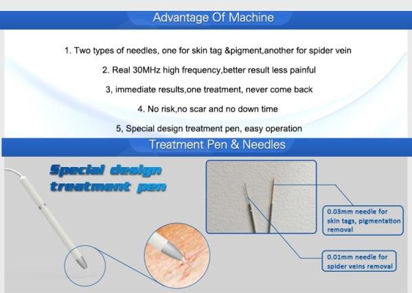 30MHz RBS facial high frequency portable vascular spider vein removal machine with 3 years warranty
