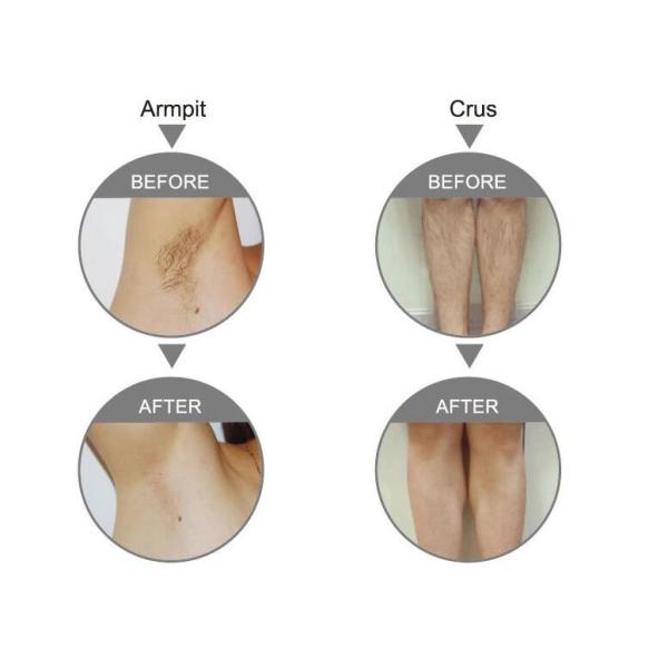 4 In 1 E - Light IPL Opt Yag Laser Tattoo Removal Machine , SHR Laser Hair Removal Device