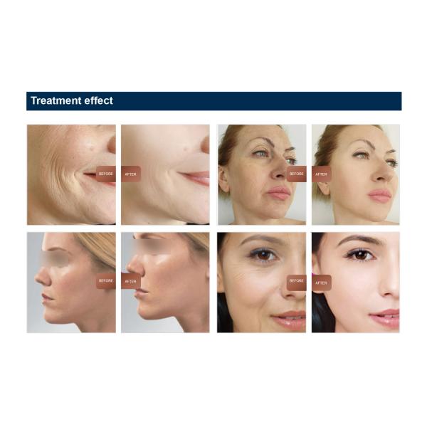 Advanced Desktop EMS RF Face Sculpting Machine for Skin Tightening and Wrinkle Removal