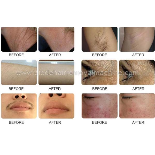 Medical Ipl Permanent Laser Hair Removal Device 1 - 10 Hz Frequency Long Life Time