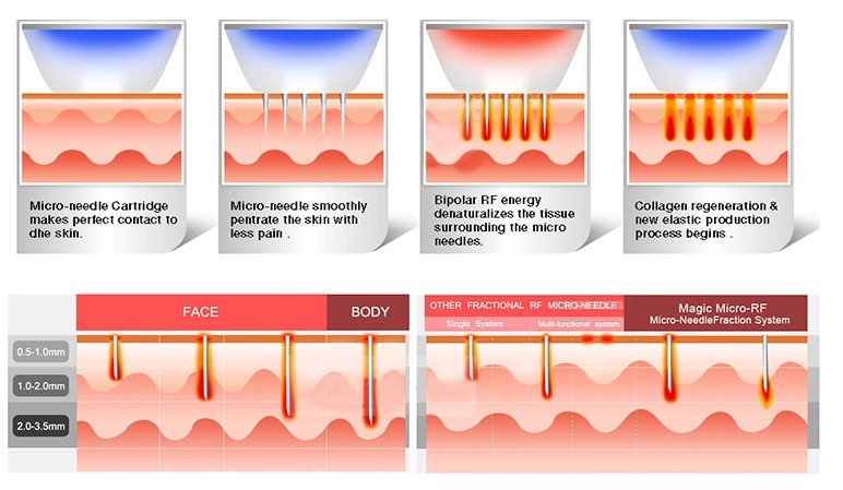 Машина удаления Марк простирания RF частичная Microneedle