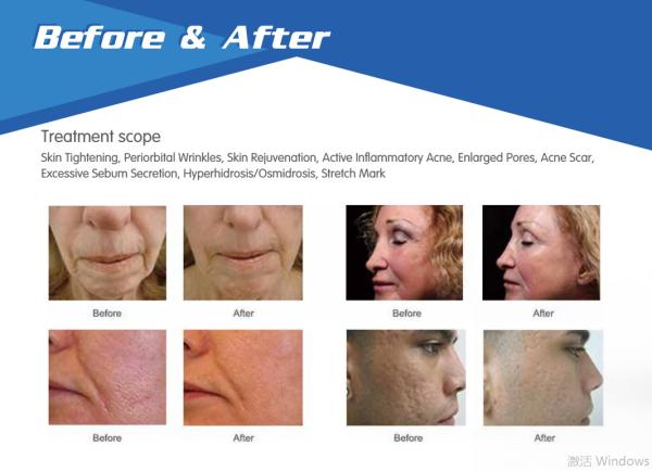Best professional OEM / ODM fractional rf micro needle skin tightening  wrinkle removal machine for beauty salon use