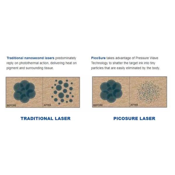 Picosure Q Switched Nd Yag Laser Machine For Freckles / Pigment / Age Spots Removal
