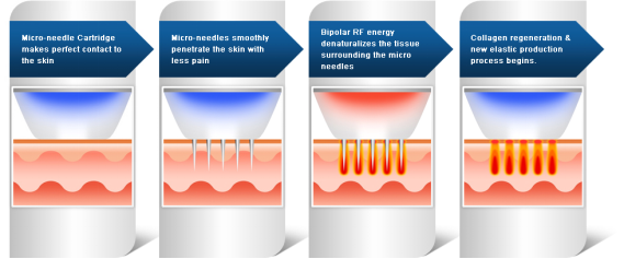 Портативное оборудование для омоложения Microneedle RF красоты частичное затягивая
