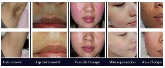 Ipl Opt Permanent Hair Removal Laser Machine ISO13485 Certification