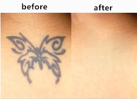 3 в 1 машине удаления волос Multfunction SHR для кожи затягивая, удаление татуировки