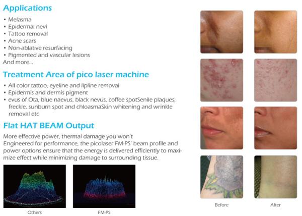 2000W Q switch Nd Yag laser tattoo removal machine for clinic /  tattoo removal laser