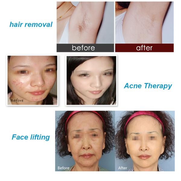 Skin Tightening Optical Ipl Hair Removal Machine 610nm Multi Pulse